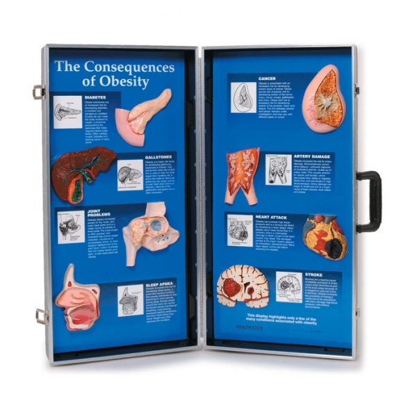 The Consequences of Obesity 3-D Display