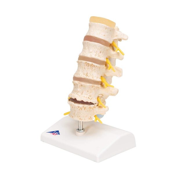 STAGES OF DISC PROLAPSE (A795) - Image 4