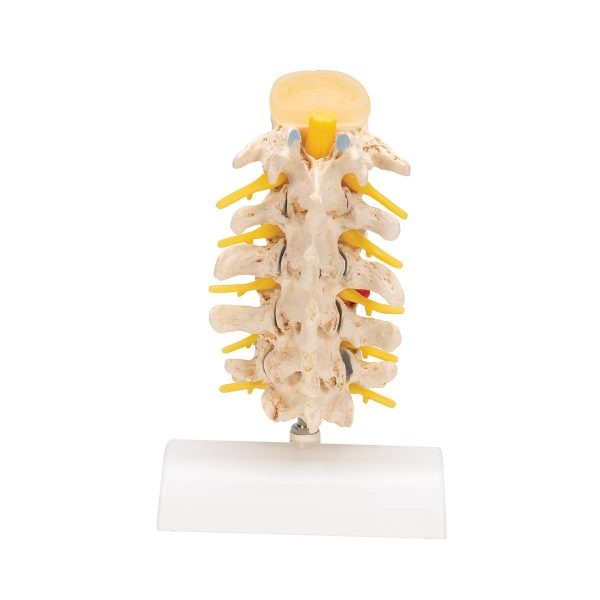 STAGES OF DISC PROLAPSE (A795) - Image 3