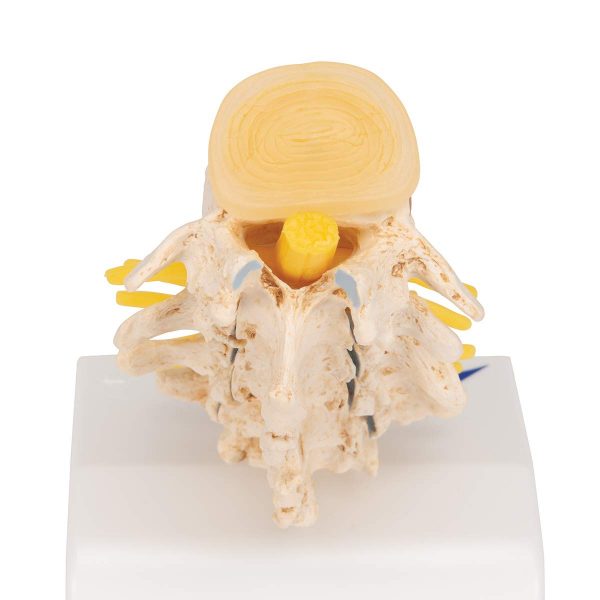 STAGES OF DISC PROLAPSE (A795)