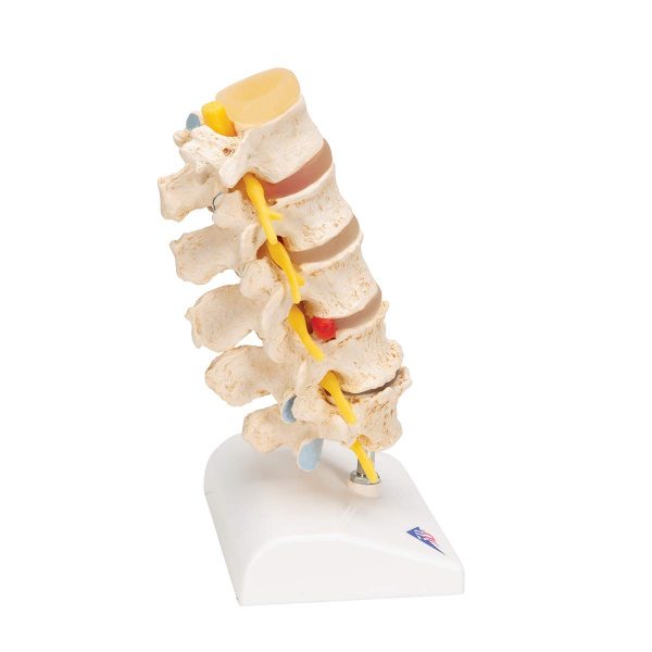 STAGES OF DISC PROLAPSE (A795) - Image 2